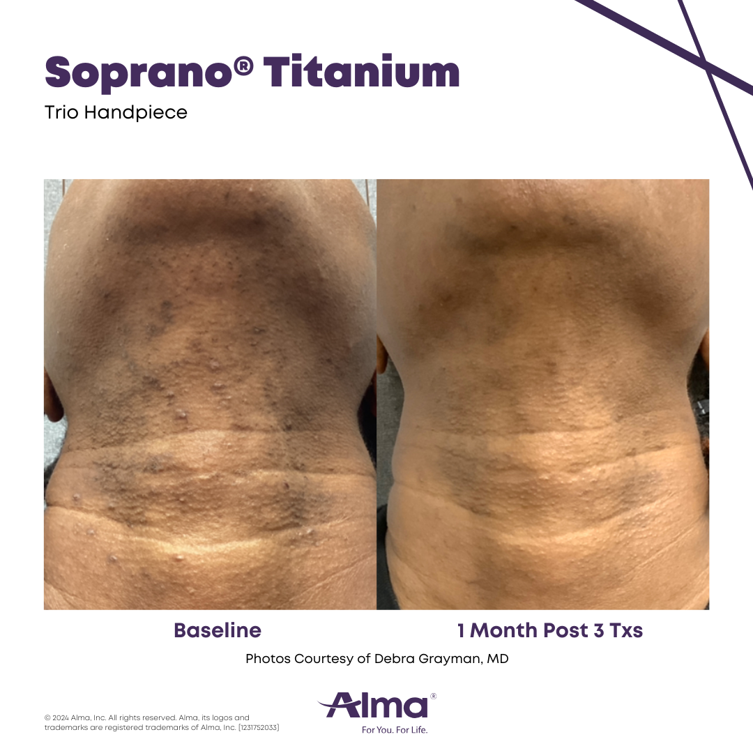 Soprano Laser Hair Removal