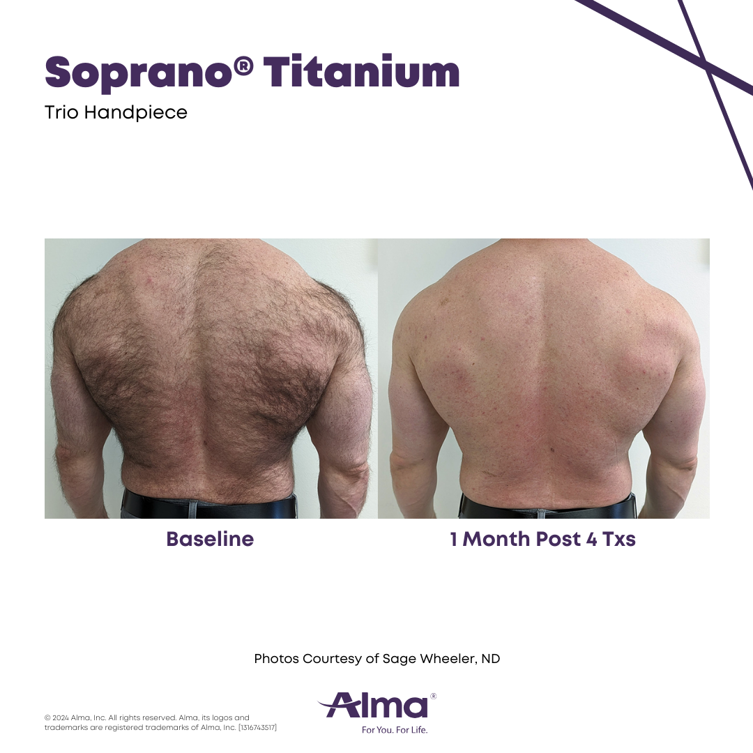 Soprano Laser Hair Removal