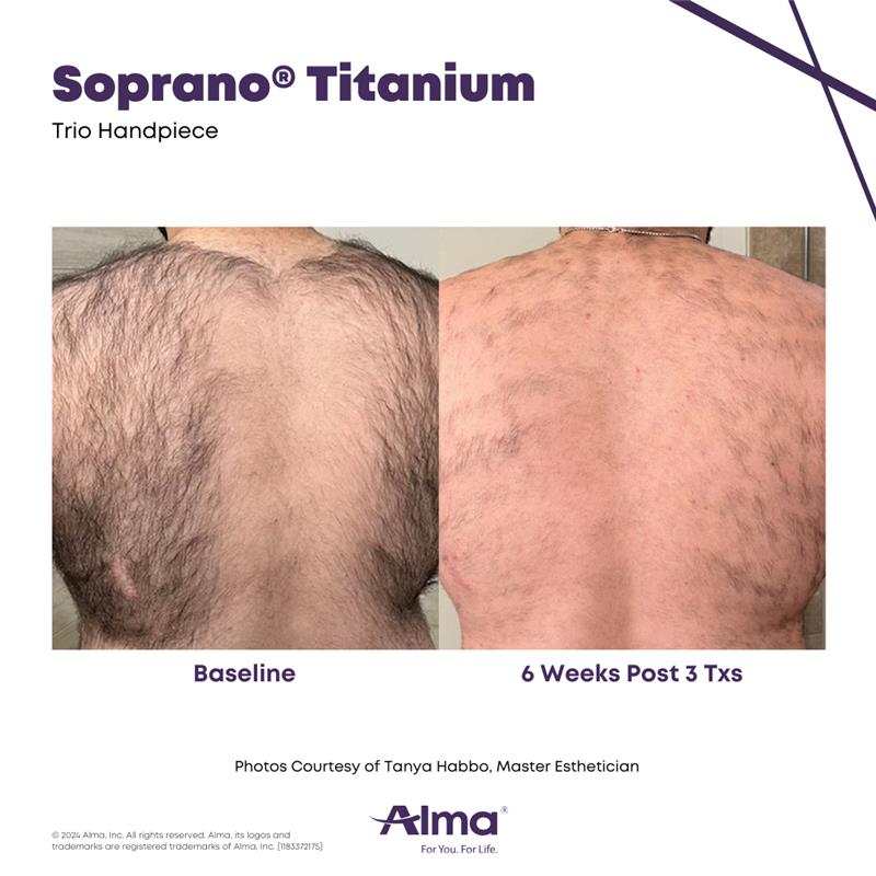 Soprano Laser Hair Removal